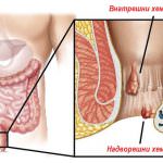 Hemorrhoids__Causes__Complications___Treatment_PADYPADY_STORY_7377