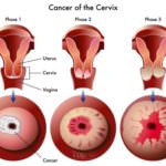 cervical-ancer