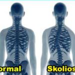 scoliosis atau skoliosis