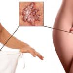 HPV