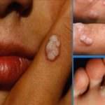 HPV