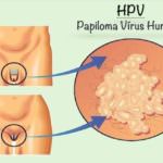 HPV1
