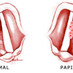HPV2