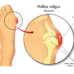 Hallux-valgus