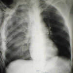 Pulmonary_contusion