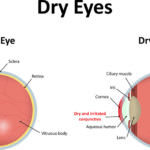 Dry Eyes Illustration