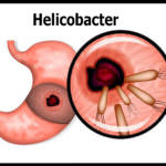 eliminar-helicobacter-pylori