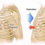 flail- chest