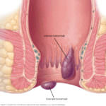 hemoroidi 1