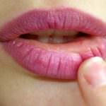 Herpes