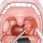 Tonsillectomy1
