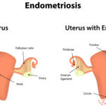 endometrioza (1)