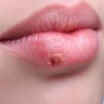 herpes1