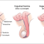 inguinalhernia