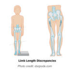 limb-deformity-length-discrepancy_02
