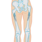 limb-length-discrepancy1
