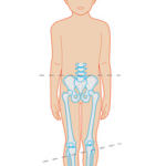 limb-length-discrepancy2