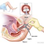 pap-test