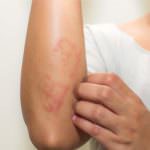 psorijazen artritis