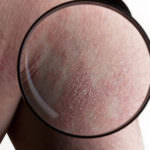 psorijazen artritis2