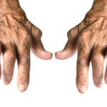 revmatski artritis 1