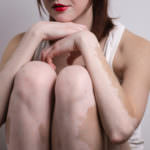 vitiligo (2)
