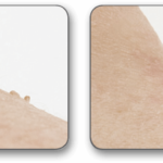 fibromi (1)