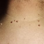 fibromi-vrat
