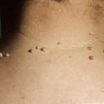 fibromi-vrat