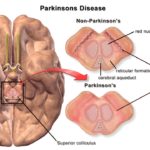 parkinsonova-bolest (1)