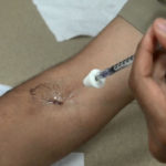 dermatitis-tretman