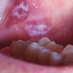 leukoplakija
