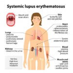 lupus1 (4)