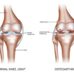 osteoartritis
