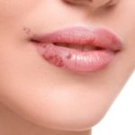 HERPES 3