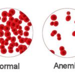 anemija