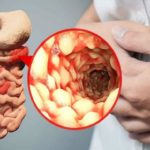 Crohns-Disease