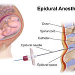 Epidural_Anesthesia
