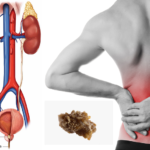Why-do-you-get-a-Kidney-Stone-and-what-are-the-curative-measures