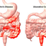 crohn_ulcerative_colitis