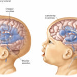 hidrocefalus (1)