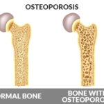 osteo3
