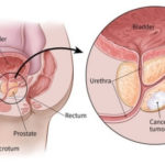 rak-na-prostata (1)