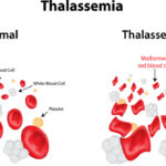 thalassemia-red-blood-cells