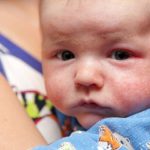Eczema on face of newborn