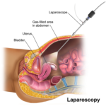 Blausen_0602_Laparoscopy_02