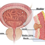 Bladder Cancer