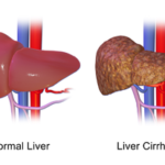 Liver_Cirrhosis