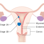 endometrium