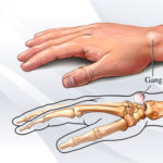 ganglion2